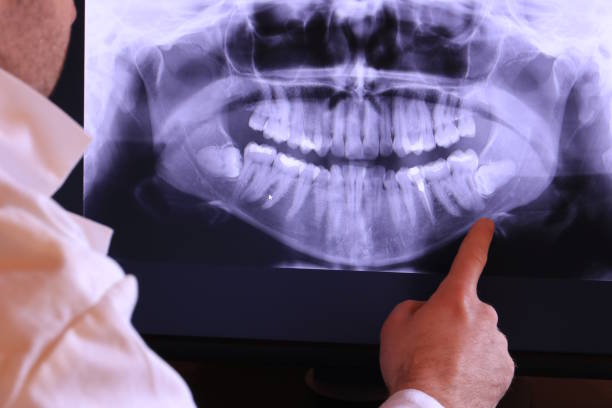 Best Emergency Dentist for Lost Fillings or Crowns in Winchester, IL