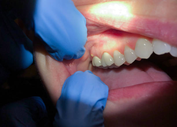 Best Broken or Cracked Tooth Emergency Dentist in Winchester, IL